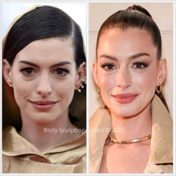 Anne Hathaway’s Plastic Surgery In 2 Rhinoplasty, Boob Job, & Botox Injection Rumors Examined!