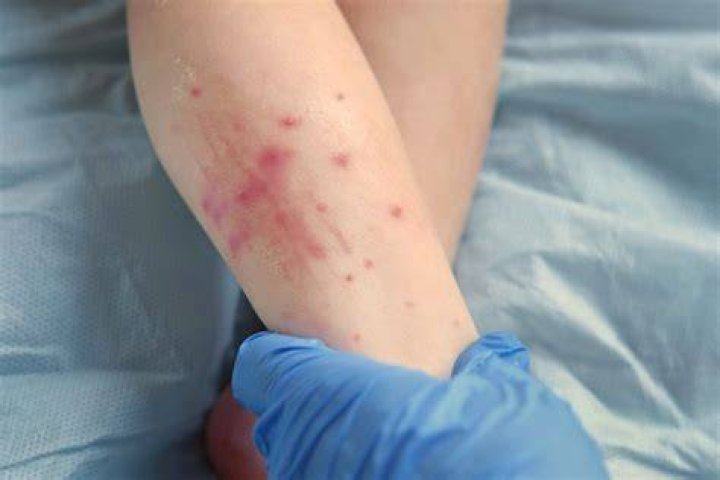 CDC Issues New Measles Alert for Travelers Going to 46 Countries